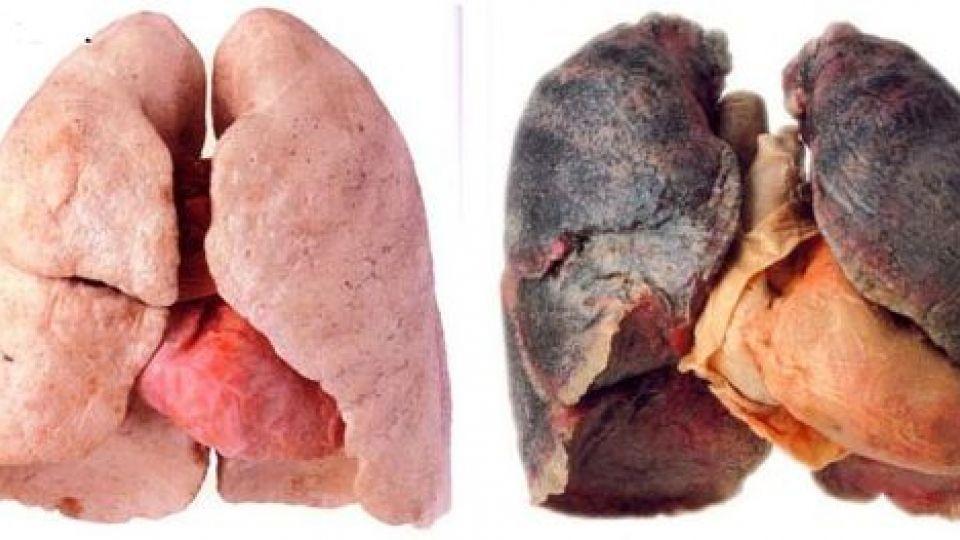 ویدئویی دلخراش از مضرات مصرف سیگار
